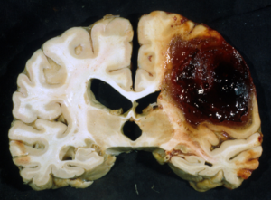 cerebro